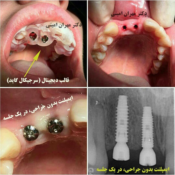 ایمپلنت به روش کاملا دیجیتال بدون برش و جراحی