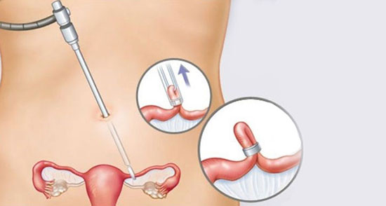 توبکتومی یا بستن لوله‌های رحم چیست و چگونه انجام می‌شود