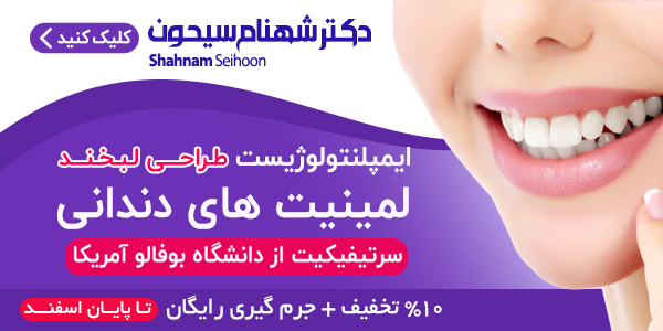 لمینت دندان، قیمت سال ۹۸ و جدیدترین انواع آن +ویدئو لمینت دندان، قیمت سال ۹۸ و جدیدترین انواع آن +ویدئو