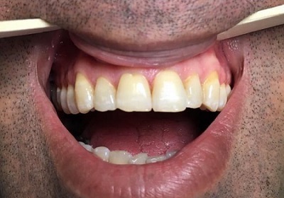 لمینت دندان، قیمت سال ۹۸ و جدیدترین انواع آن +ویدئو لمینت دندان، قیمت سال ۹۸ و جدیدترین انواع آن +ویدئو