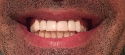 لمینت دندان، قیمت سال ۹۸ و جدیدترین انواع آن +ویدئو