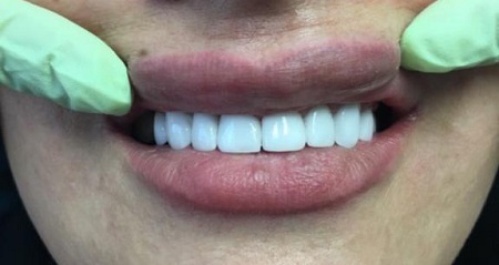 لمینت دندان، قیمت سال ۹۸ و جدیدترین انواع آن +ویدئو لمینت دندان، قیمت سال ۹۸ و جدیدترین انواع آن +ویدئو