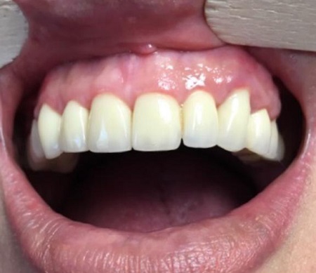 لمینت دندان، قیمت سال ۹۸ و جدیدترین انواع آن +ویدئو لمینت دندان، قیمت سال ۹۸ و جدیدترین انواع آن +ویدئو