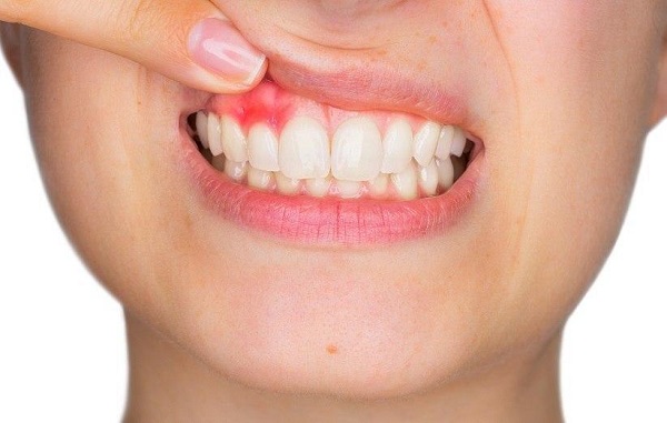 مراقب این بیماری شایع لثه باشید