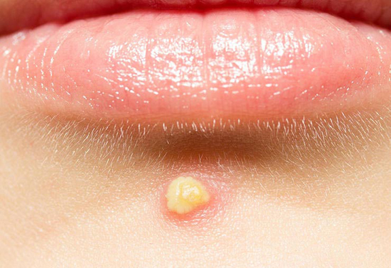 انواع جوش صورت و راه درمان آن‌ها