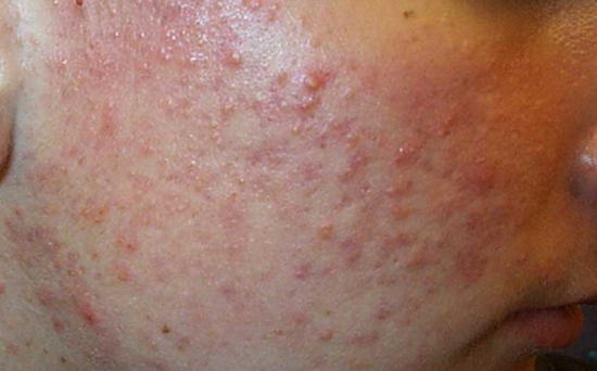 انواع جوش صورت و راه درمان آن‌ها