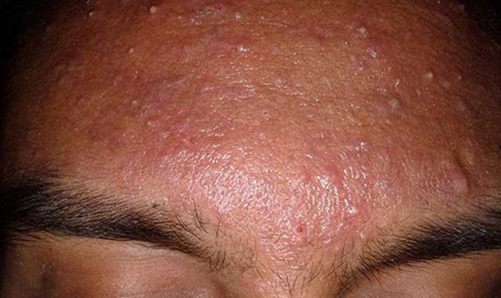 انواع جوش صورت و راه درمان آن‌ها