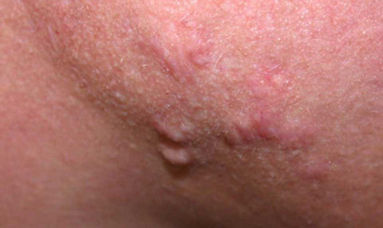 انواع جوش صورت و راه درمان آن‌ها