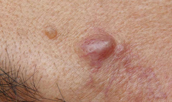 انواع جوش صورت و راه درمان آن‌ها