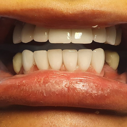 لمینت دندان، قیمت سال ۹۸ و جدیدترین انواع آن +ویدئو لمینت دندان، قیمت سال ۹۸ و جدیدترین انواع آن +ویدئو