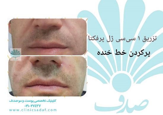 تزریق چربی به صورت و هزینه آن