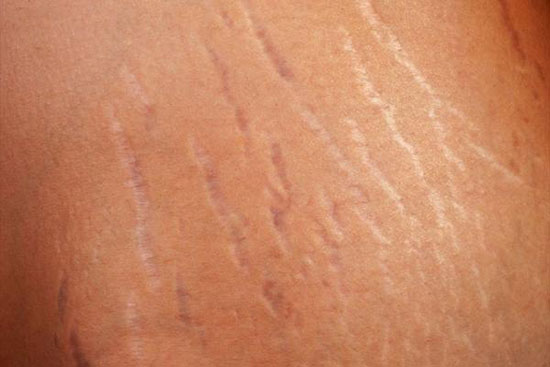 رفع سیاهی پای چشم با کربوکسی تراپی