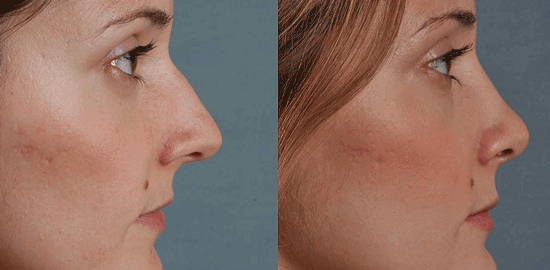 دماغ سربالا و هزار دردسر/ بازار داغ جراحی بینی دماغ سربالا و هزار دردسر/ بازار داغ جراحی بینی