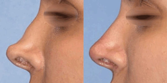 ترمیم بینی جراحی شده؛ چرا بینی شما نیاز به ترمیم دارد؟