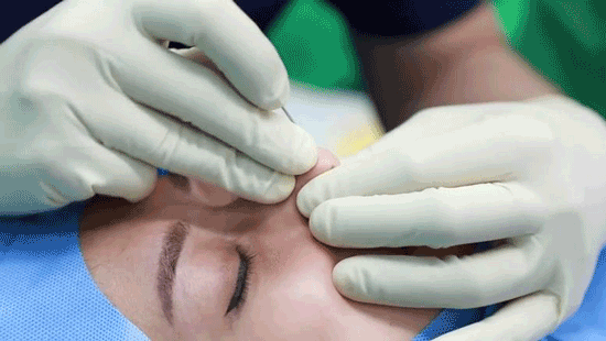 لیفت بینی با نخ و هرآنچه باید بدانید