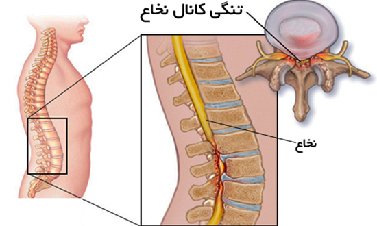 تنگی کانال نخاع کمری، علایم و شیوههای درمان تنگی کانال نخاع کمری، علایم و شیوههای درمان