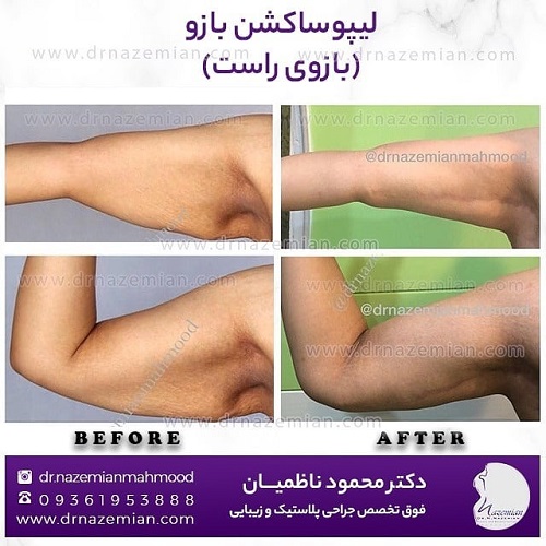 دکتر محمود ناظمیان – فوق تخصص جراحی پلاستیک و زیبایی کدام جراحی لاغری مناسب شماست؟
