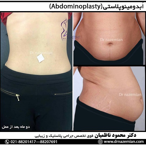 دکتر محمود ناظمیان – فوق تخصص جراحی پلاستیک و زیبایی کدام جراحی لاغری مناسب شماست؟