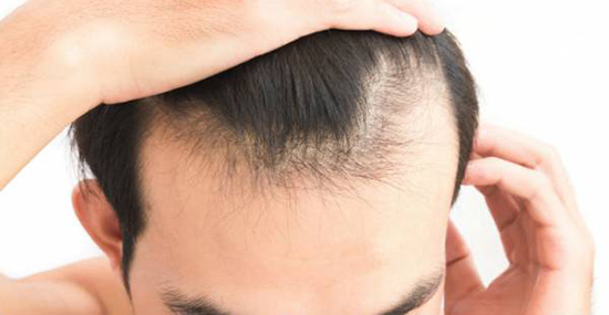 چرا ریزش مو میگیریم؟ چرا ریزش مو میگیریم؟
