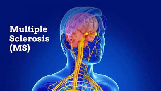 شاید برای شما هم اتفاق بیفتد؛ ام اس شاید برای شما هم اتفاق بیفتد؛ ام اس