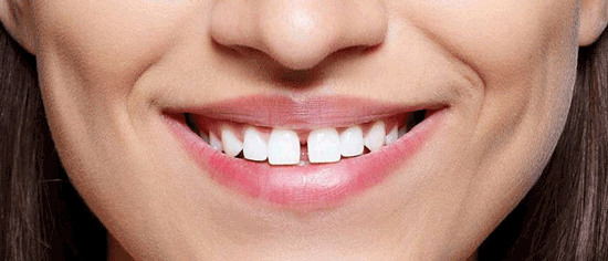 بستن فاصله میان دندان‌ها؛ بهترین روش کدام است؟