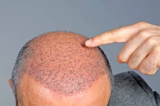 دلایل ریزش مو در مردان؛ هراسِ کچلی