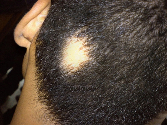 دلایل ریزش مو در مردان؛ هراسِ کچلی