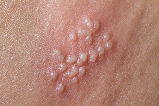 تبخال تناسلی در مردان