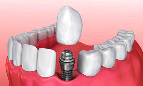 انواع ایمپلنت دندان و هزینه‌ی آن‌ها